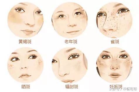 臉上雀斑|4大雀斑成因+5種去斑方法 比拼熱門去斑療程｜Beauty 